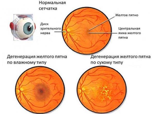После замены хрусталика глаз видит мутно - причины и что делать
