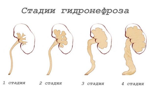 Правильное питание и диета при гидронефрозе. питание при гидронефрозе у детей