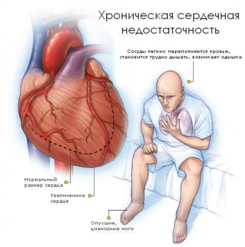 Кашель при сердечной недостаточности: симптом, требующий внимания