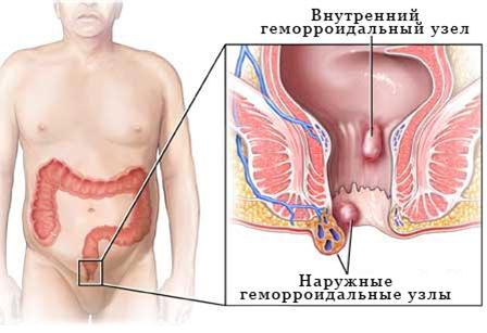 Геморрой – причины возникновения у мужчин и женщин, от чего появляется геморрой после родов?
