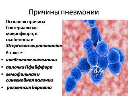 Острая пневмония
