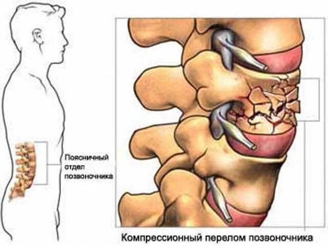 Мануальная терапия при компрессионном переломе позвоночника