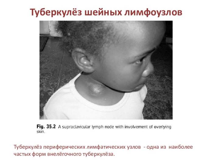 Туберкулез лимфатических узлов