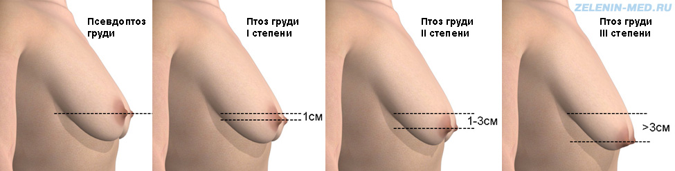 Птоз грудных (молочных) желез – причины и что делать