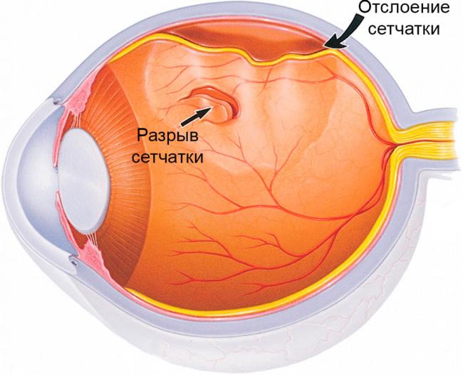 Лечение разрыва сетчатки глаза