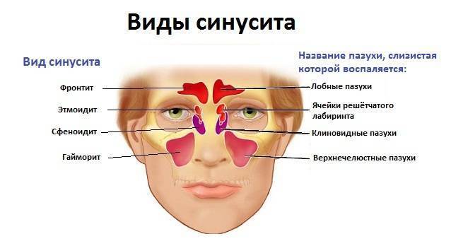 Лечение гайморита в домашних условиях у взрослых народными средствами
