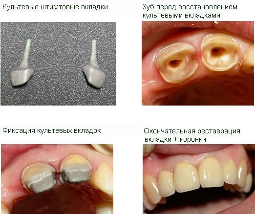 Виден штифт из пломбы