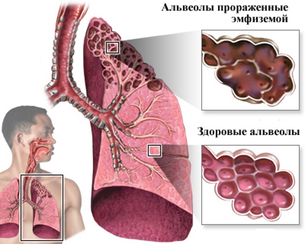 Что такое эмфизема лёгких и как ее лечить