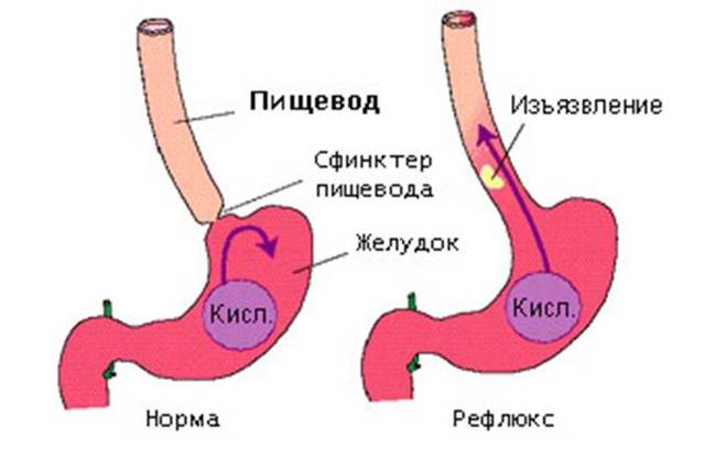 Основные принципы диеты при эзофагите