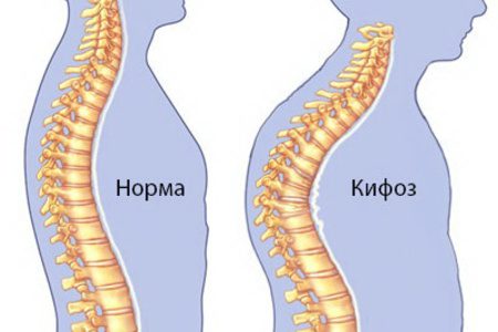 Что такое сколиоз у детей и как его вылечить?
