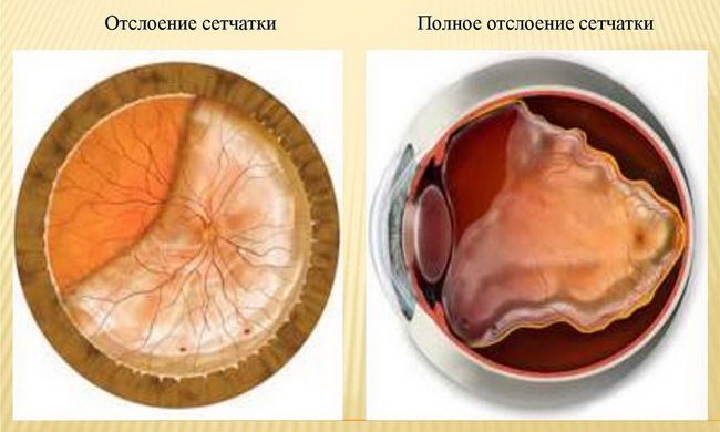 Отслойка сетчатки глаза