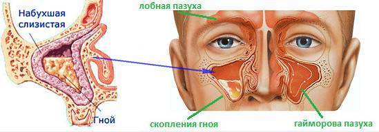 Самые эффективные народные средства лечения гайморита