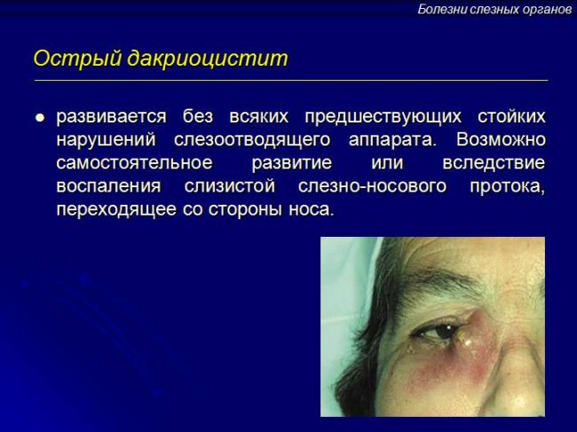 Что такое дакриоаденит, или воспаление слезной железы, и как его лечить у ребенка и взрослого