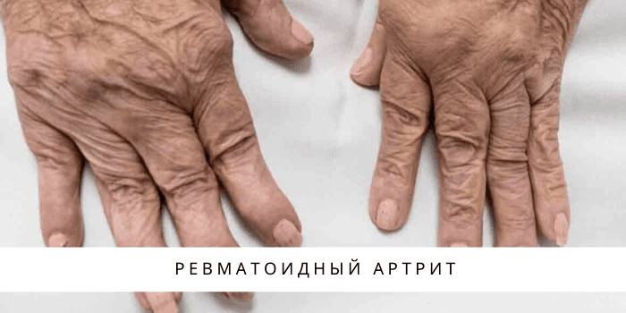 Лечение ревматоидного артрита