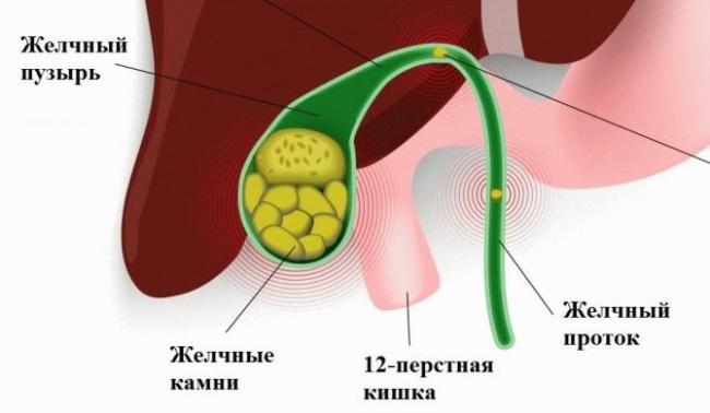 Желчнокаменная болезнь (калькулёзный холецистит). причины, симптомы, современная диагностика и эффективное лечение камней в желчном пузыре.