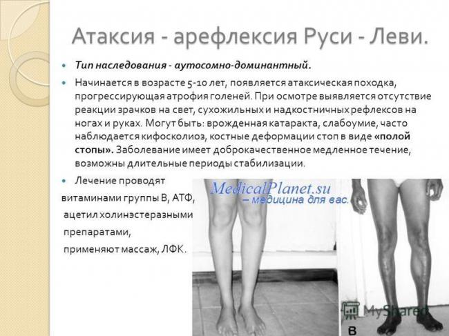 Невральная амиотрофия шарко-мари-тута