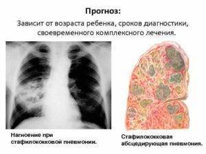 Стафилококковая пневмония: симптомы и лечение