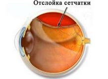 Когда и как лечится отслоение сетчатки