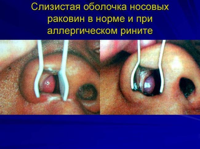 Атрофический ринит – что это такое и как лечится