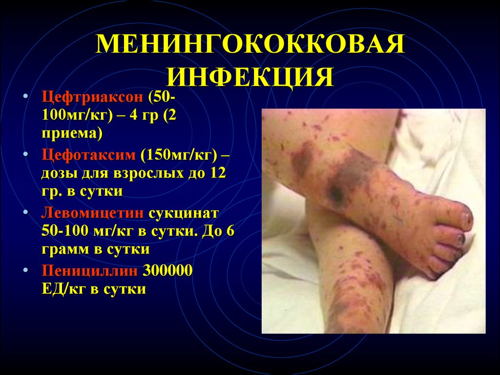 Менингококковая инфекция (менингококк): заражение, признаки, как лечить, профилактика