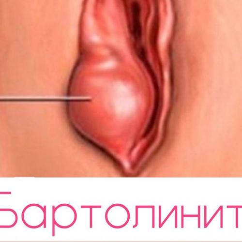 Бартолинит: причины, симптомы, лечение и последствия. народные методы лечения. операция при бартолините. применение при бартолините гипретонических компрессов, мази вишневского, антибиотиков, мазь левомеколь :: polismed.com