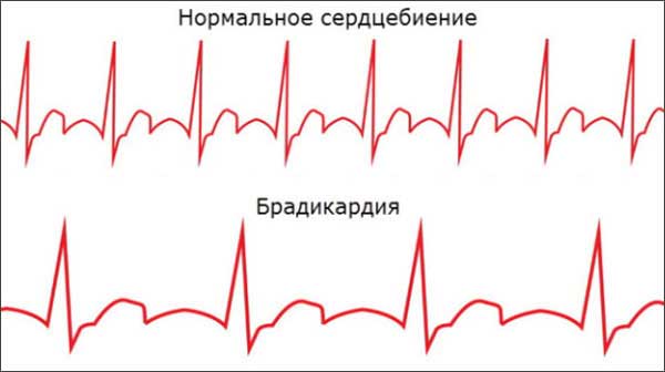 Синусовая брадикардия сердца: что это такое, причины, лечение и прогноз