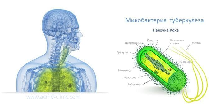 Левосторонняя пневмония у ребенка и правосторонняя – как лечить воспаление легких