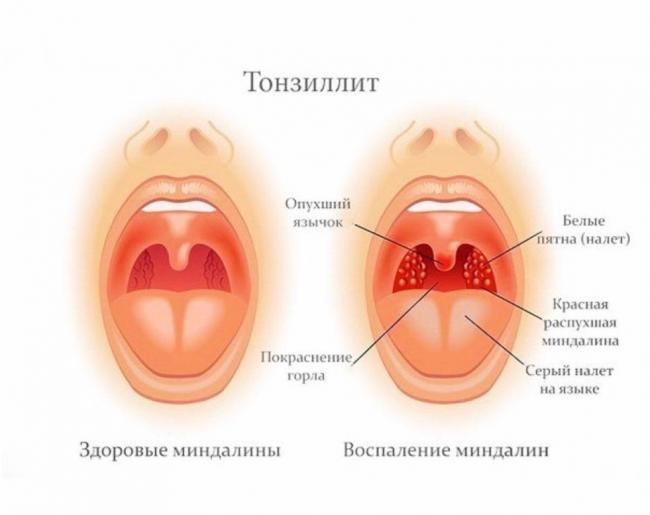 Миндалины в горле