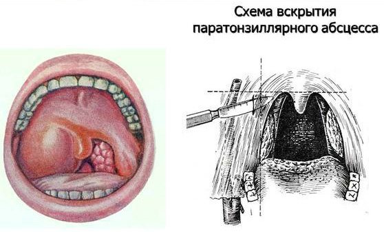 Абсцесс паратонзиллярный горла