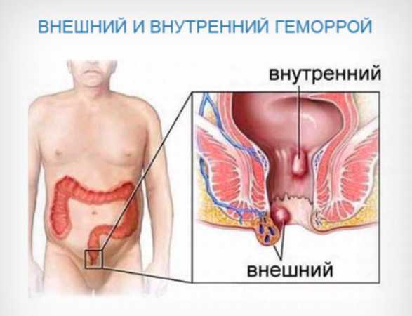Зуд в заднем проходе ночью у мужчин