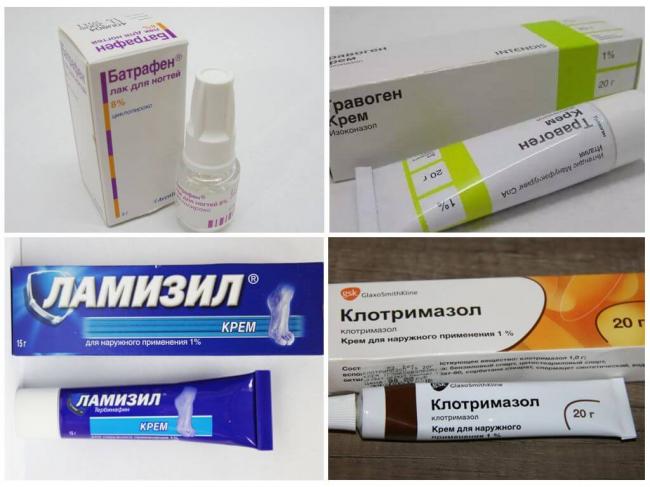 Онихомикоз