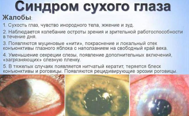 После замены хрусталика глаз видит мутно - причины и что делать