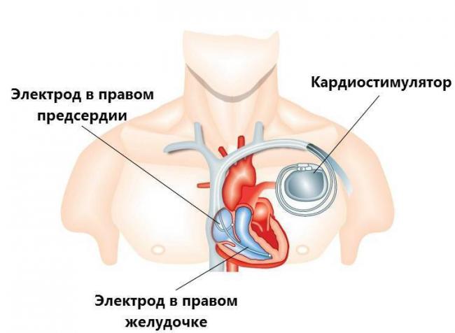 Препараты от тахикардии при нормальном давлении и учащенном пульсе
