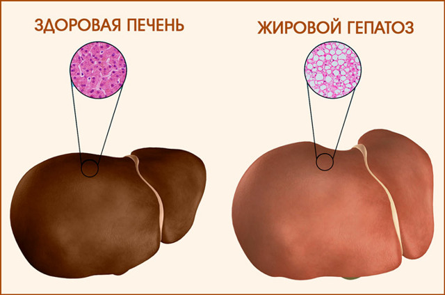 Правильная диета при жировой дистрофии печени