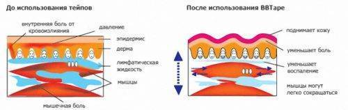 Тейпы кинезио можно ли при грыже позвоночника