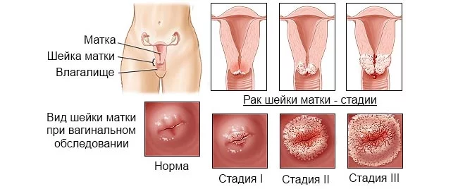 Рак шейки матки: как себя обезопасить?