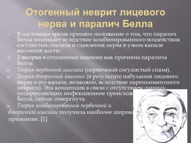 Причины возникновения пареза лицевого нерва