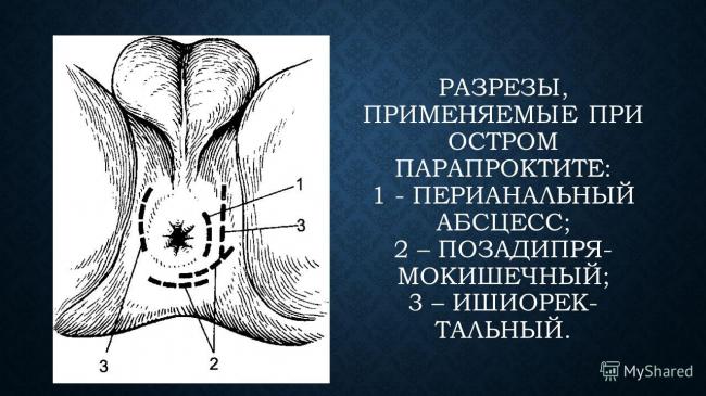 Парапроктит - симптомы, лечение, операция