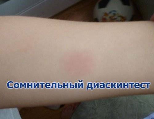 Что такое отрицательный результат диаскинтеста + фото как выглядит