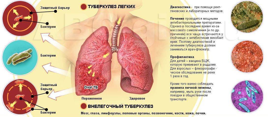 Специфика лечения туберкулеза лимфатических узлов