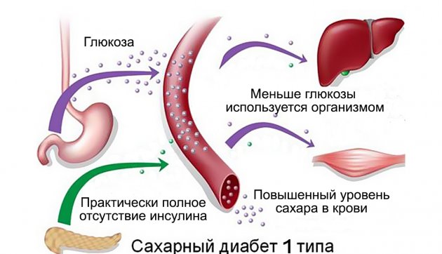 Сахарный диабет 1 типа. когда он бывает?