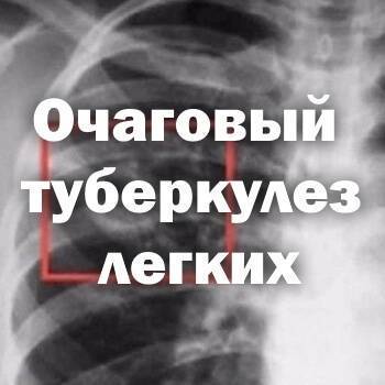 Очаговый туберкулез легких лечение