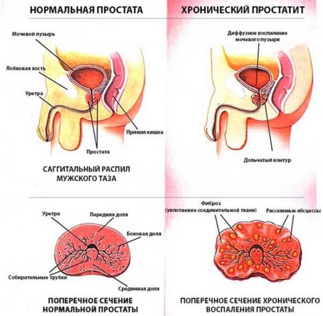 Простатит — мужская болезнь с не мужскими симптомами