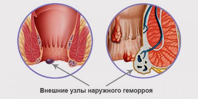Наружный геморрой: симптомы, причины и лечение