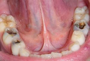 Зубные капли Dental drops инструкция по применению