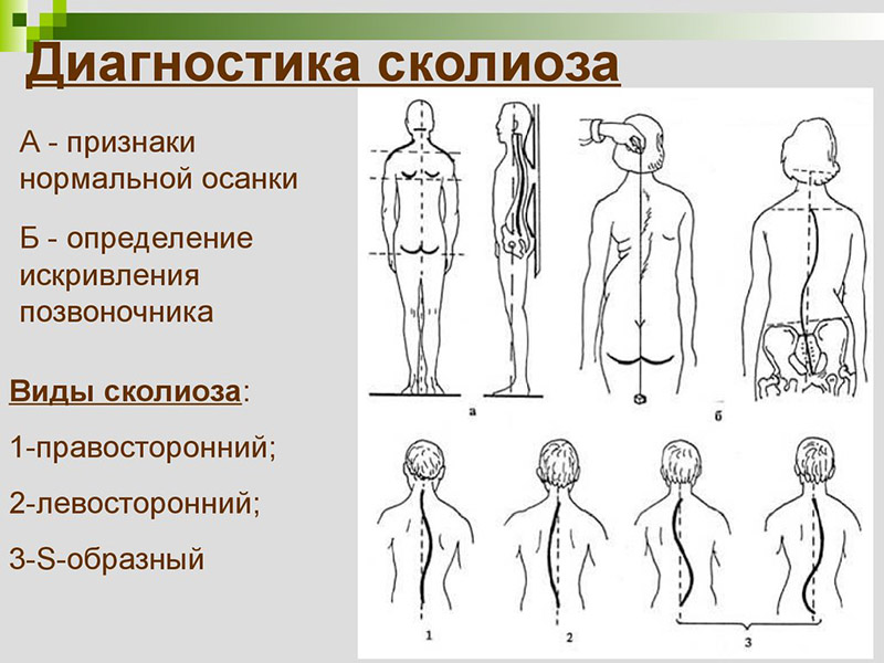 Как лечить сколиоз у детей?