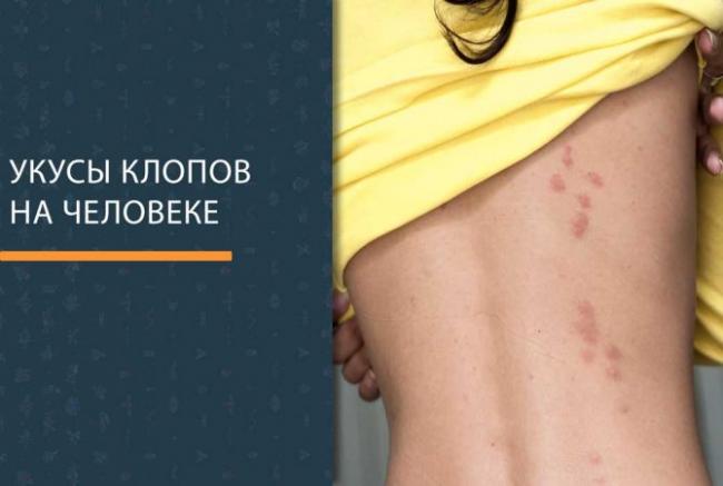 Следы от укусов клопов, как избавиться от укусов клопов на теле