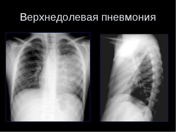 Сегментарная пневмония: правосторонняя и левосторонняя, лечение