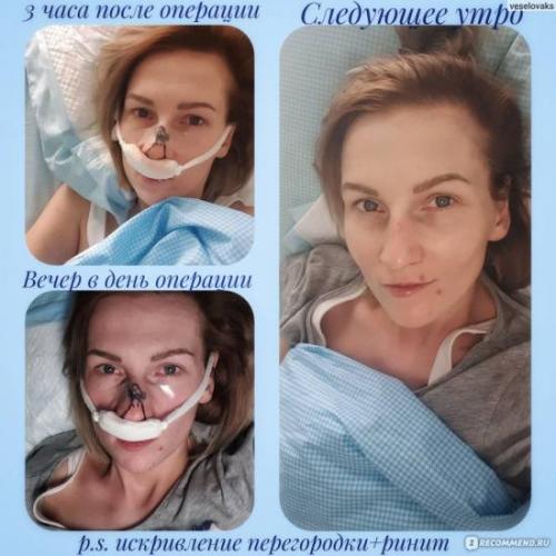 Операция по исправлению носовой перегородки