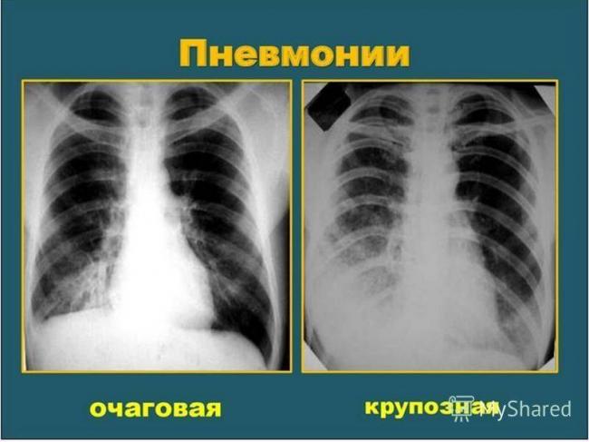 Чем отличается пневмония от туберкулеза и может ли одно заболевание перейти в другое?